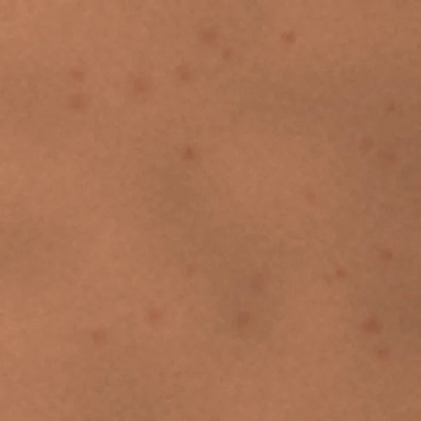 Acne & blemishes: illustrative after image